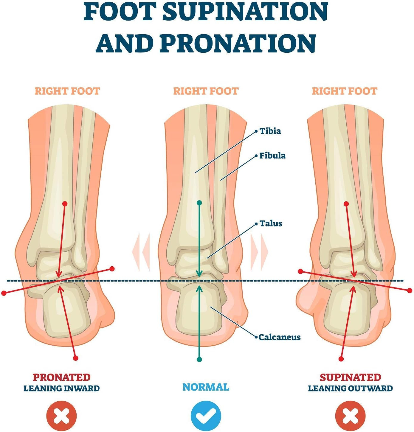 Heel Wedge Inserts Pronation Supination Correction Leather Shoe Insoles Medium
