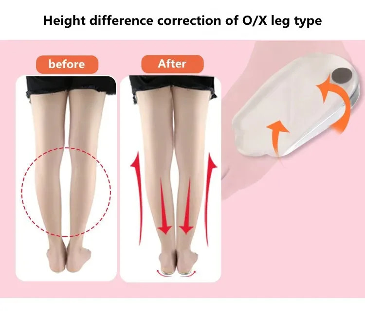 Silicone Orthopedic Insoles with Magnet Massage Foot Care O/X Leg Type Valgu Var